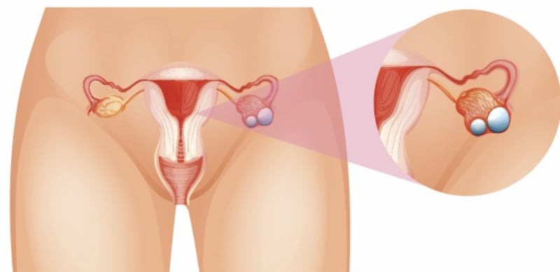 Ovarian cancer illustration.