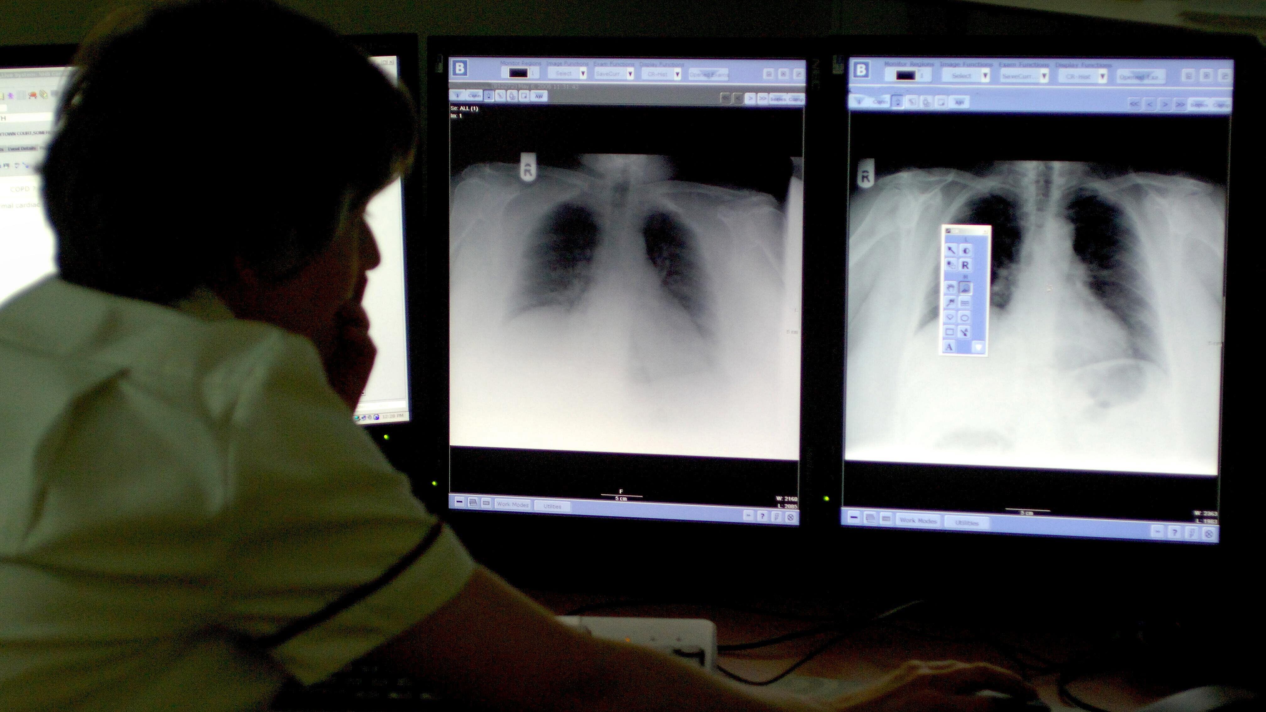 An NHS trust in Surrey found the Qure AI program identified normal chest X-rays with a 99.7% accuracy (PA)