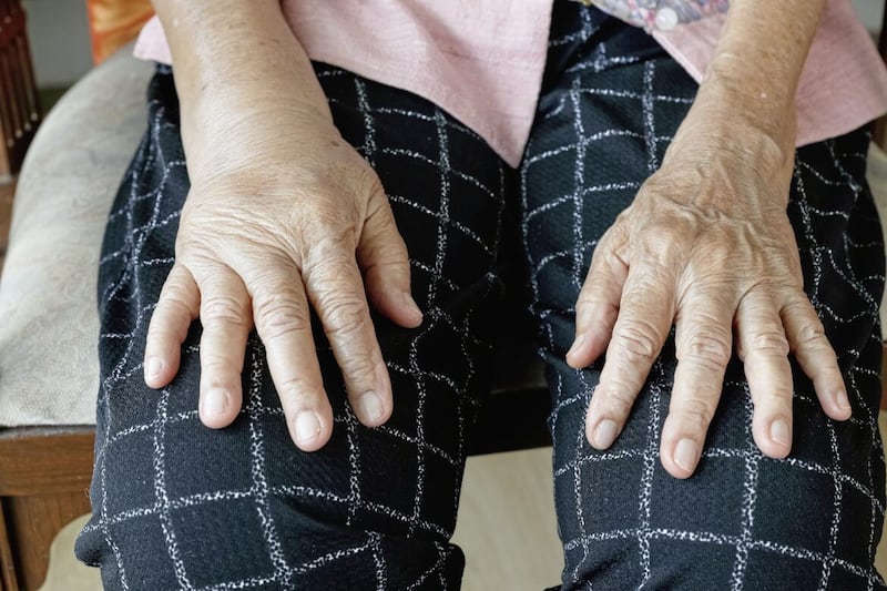 Hand oedema can be a symptom of thyroid, liver or kidney diseases 