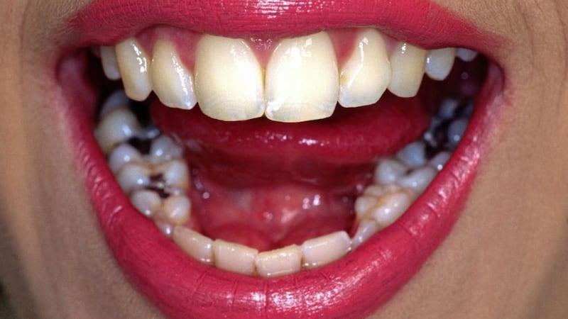 Most people will recognise dental amalgam as the silver-coloured fillings in teeth 
