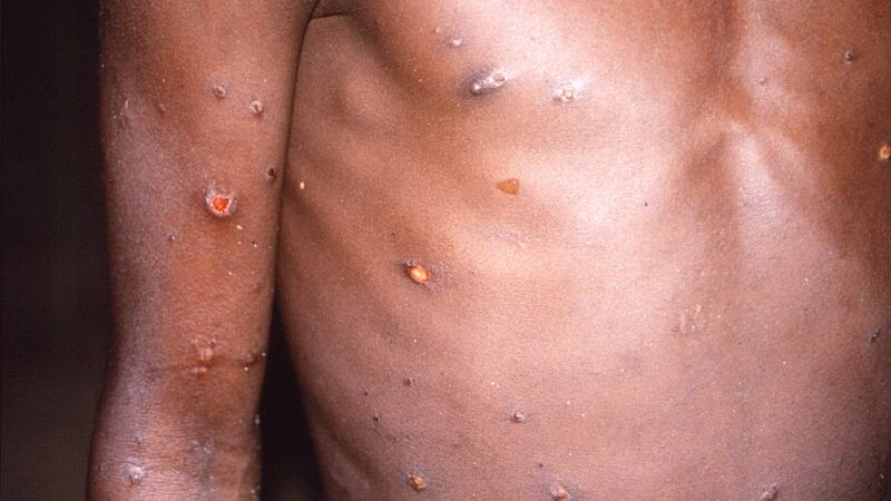 There have been 3,548 confirmed and 150 ‘highly probable’ monkeypox cases detected in the UK.