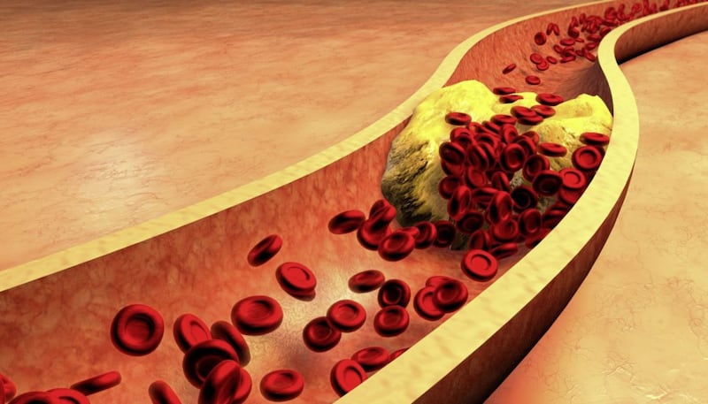 Cholesterol can be deposited in the arteries, narrowing them and increasing the risk of a heart attack and stroke 