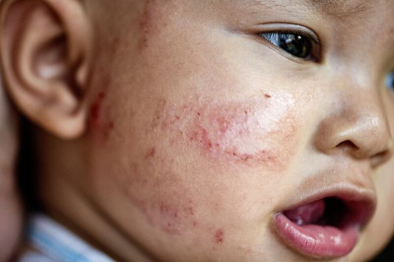 Around 20 per cent of children are affected by eczema. 