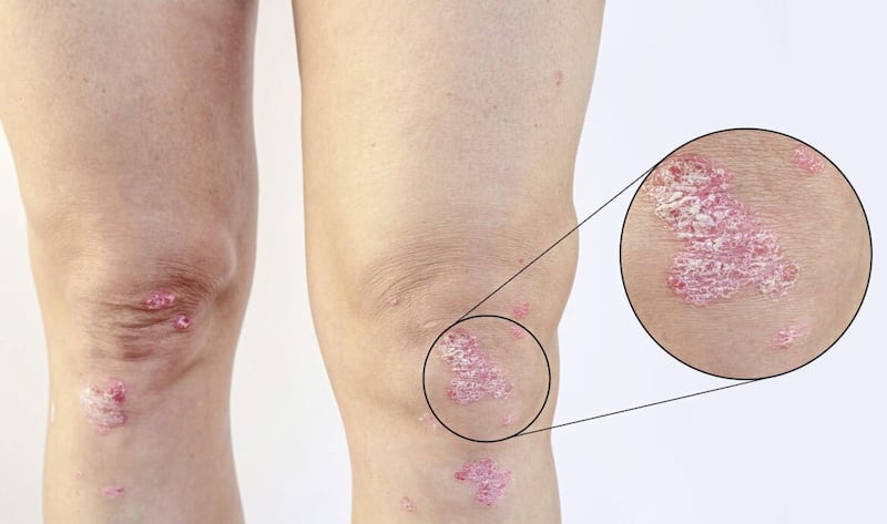 Psoriasis Know The Symptoms And How To