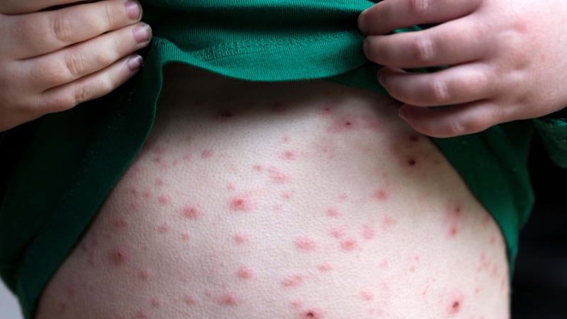Research suggests about three-quarters of parents would support a chickenpox jab being added to the childhood vaccination schedule.