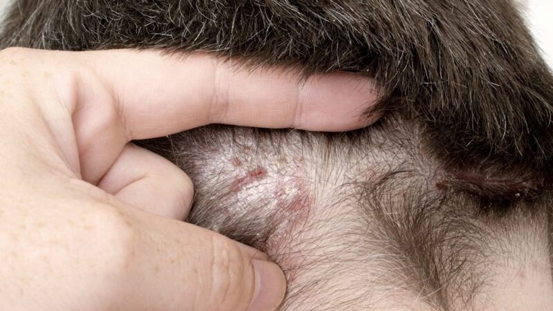 Patients can struggle physically, emotionally and socially with psoriasis 