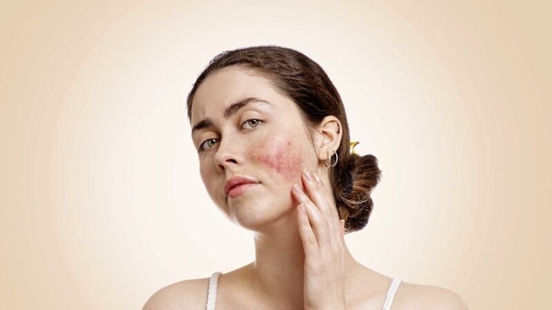 Rosacea is an inflammatory skin condition which causes red cheeks, visible blood vessels, dryness and bumpy skin texture 