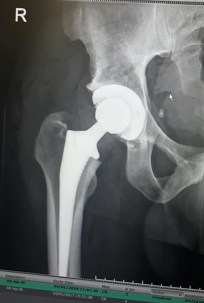 Mr Johnson had a hip replacement five years ago (Stuart Johnson/University of Bristol/PA)