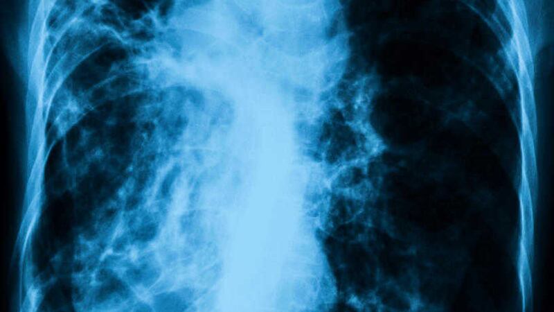 Chest x-ray image showing infection of lungs.