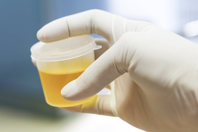 A urine sample (BENCHAMAT1234/Getty Images)