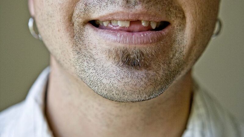 Scientists are one step closer to being able to regenerate missing teeth in humans. 