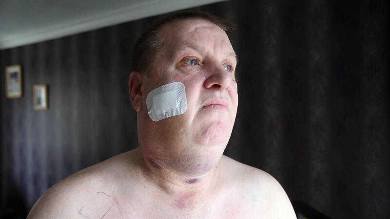 Dan Murray was shot in the face in his north Belfast home in an earlier murder attempt. Picture by Pacemaker 