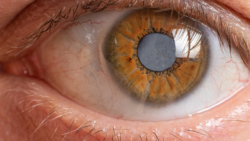 Around 80 million people globally are affected by glaucoma