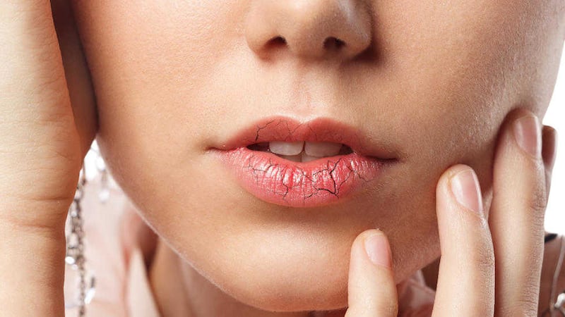 Cracked or chapped lips can be caused due to excessive licking of your lips 