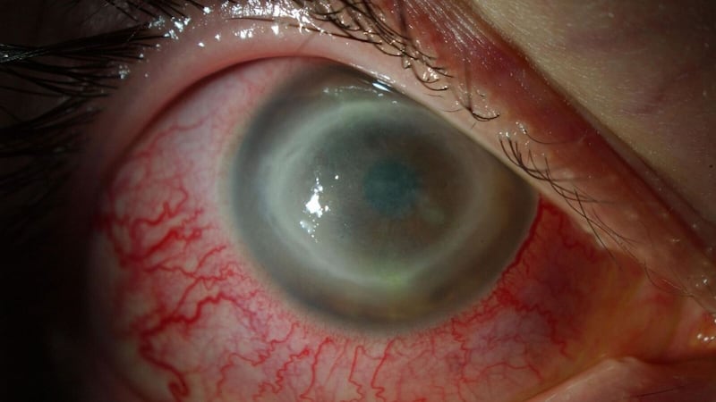 There has been a rise in the number of cases of Acanthamoeba keratitis.