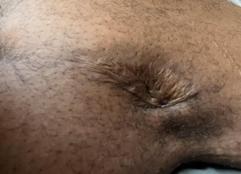 Sachmo Quain scar from bullet