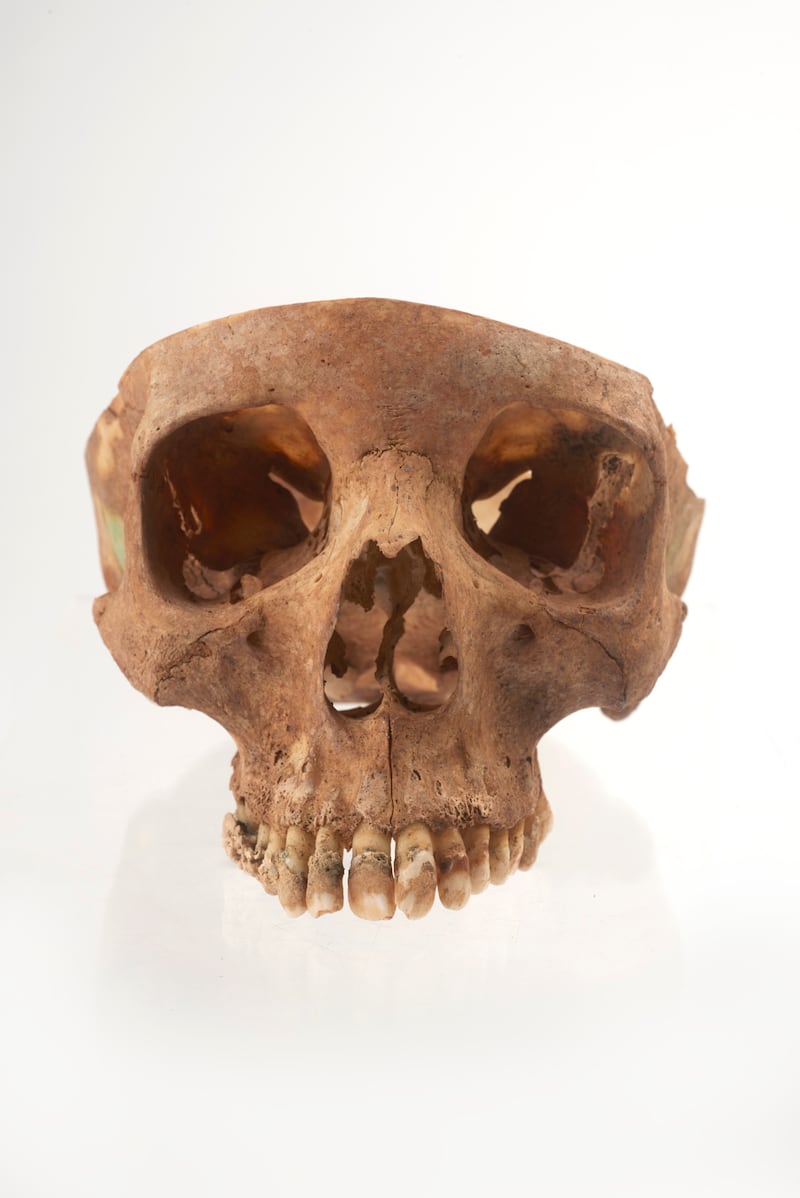 Woman's skull with severe dental plaque (Museum Of London)