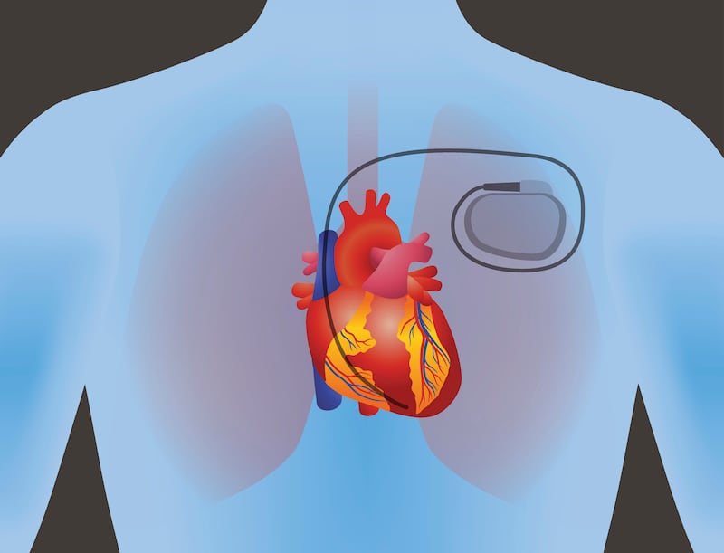 Human heart and pacemaker.