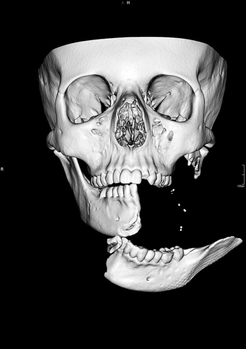 CT Scan 3D Image of injuries to Emily Eccles 