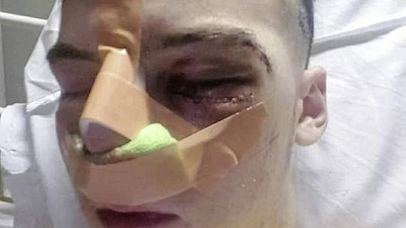 Jason Tuite, from Dundalk, who suffered a catalogue of facial injuries when he was attacked outside a Belfast Vital gig on Boucher Road on August 26. The 16-year-old has undergone surgery in Dublin and two metal plates have been permanently inserted in his face. 