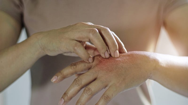An itchy rash on the hands is often caused by eczema. 