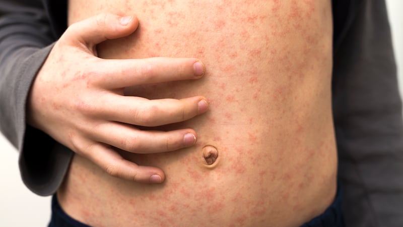 The PHA says there are no confirmed cases of measles in Northern Ireland