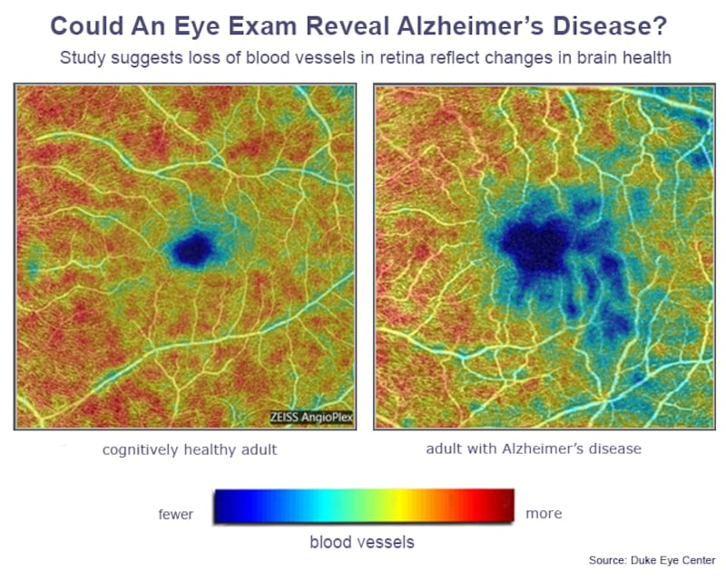 Blue patches show how webs of tiny blood vessels at the back of the eye are less dense in an Alzheimer's patient (right) compared with a healthy individual