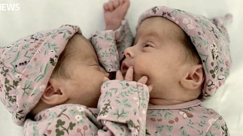 Conjoined twins Annabelle and Isabelle Bateson, from Toomebridge who were this week separated during surgery 