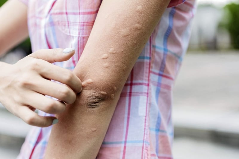 Nettle rash, or urticaria, can be a disabling and aggravating condition 