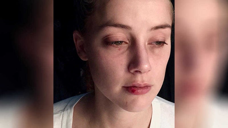 A photo issued by People Magazine of the Amber Heard appearing to have a bruised eye and cut lip which she claims were the result of Johnny Depp&#39;s abuse PICTURE: People/PA 