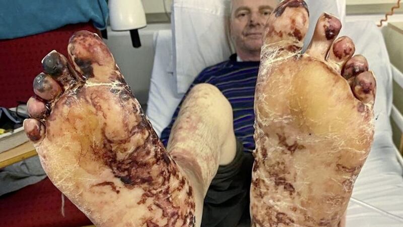 John Manley&#39;s feet a fortnight after he was hospitalised with sepsis  