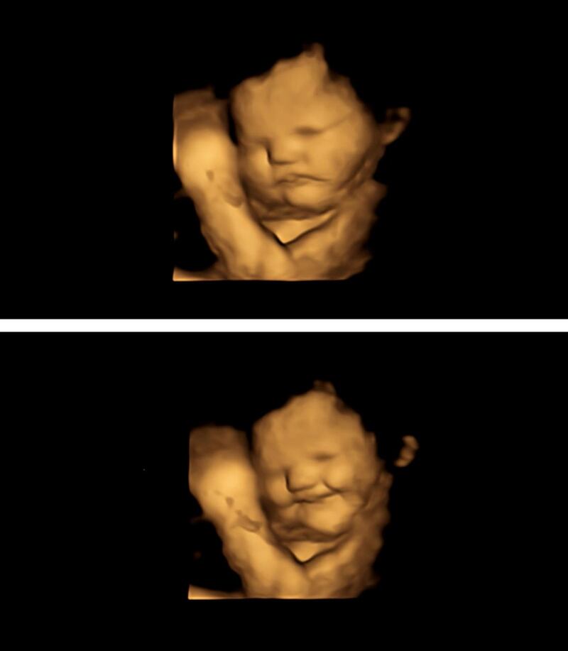 4D ultrasounds images show fetuses’ reactions to taste