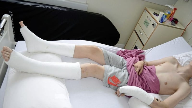 #STOPATTACKS: This picture from the PSNI shows a 15-year-old boy recovering after he was beaten by an iron bar in a paramilitary-style attack. The #Stopattacks campaign is calling for an end to violence against children and young people. 