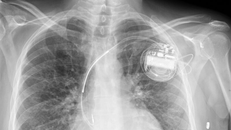 The new device could mean pacemaker patients no longer have to undergo risky surgery to replace batteries.
