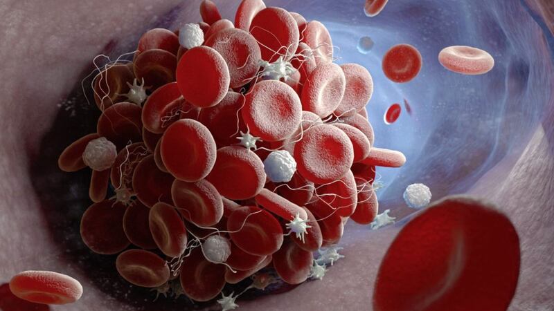 Blood clot is a generic term for a thrombosis, an obstruction of a blood vessel by a build-up of platelets and a number of different blood products 