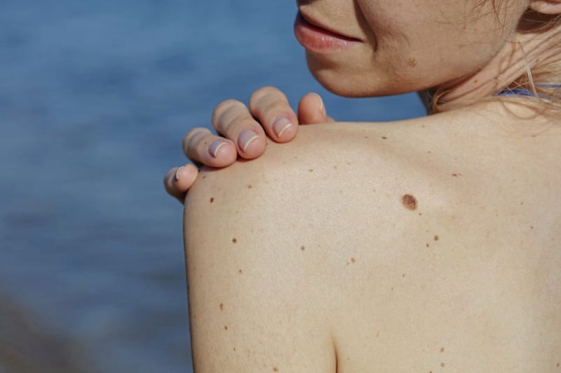 It is essential to keep an eye on moles for good skin health, noting changes in shape, size or colour. 