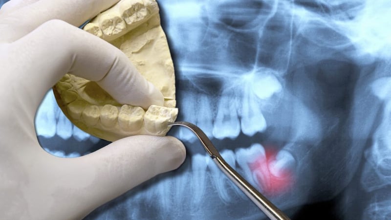 Wisdom teeth can give bother and sometimes they are tricky to fill or extract 