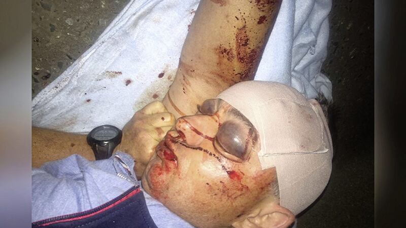 Building contractor Paschal Morgan after he was attacked in Kilkeel, Co Down 