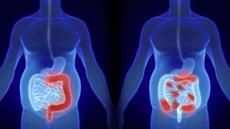 Crohn&rsquo;s disease causes inflammation in part of the gastrointestinal tract 