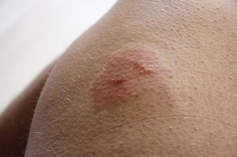 Horsefly bites can take longer to heal than mosquito bites as they cut into the skin, rather than just piercing it 