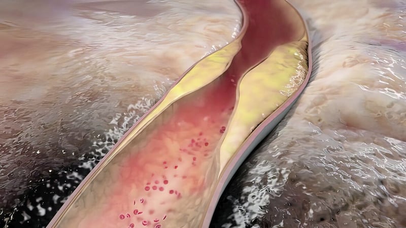 Atherosclerosis is a hardening and narrowing of your arteries caused by cholesterol plaques lining the artery over time 